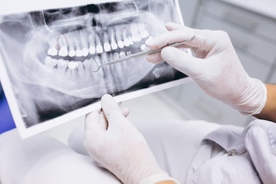 Implantes dentales